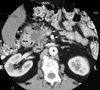 Pancreatic tumour on CT scan – More advanced (arrows) and Invading SMV